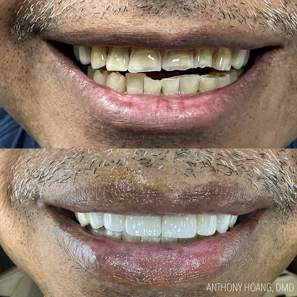 DentaL Before and After