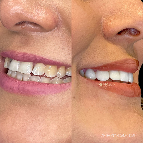 DentaL Before and After