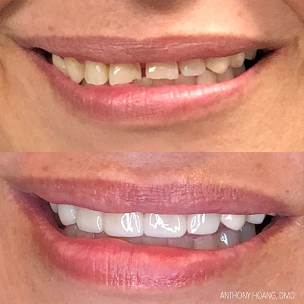 DentaL Before and After