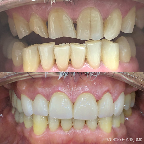 DentaL Before and After