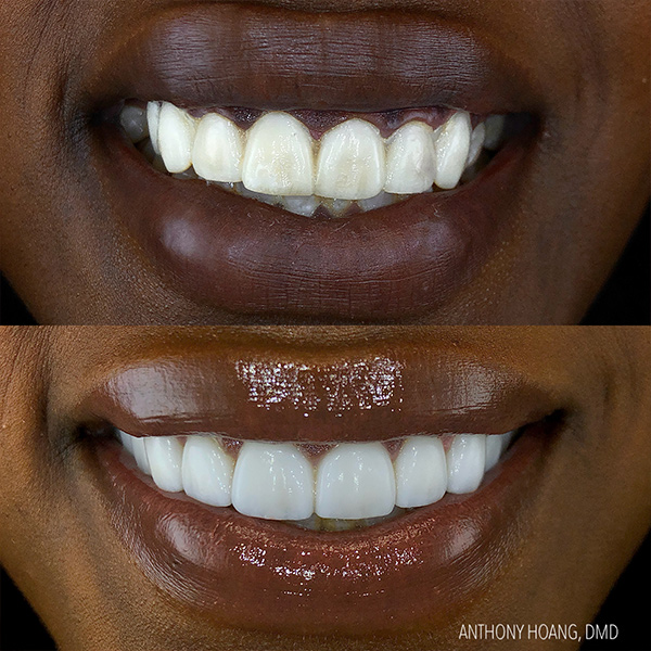 DentaL Before and After