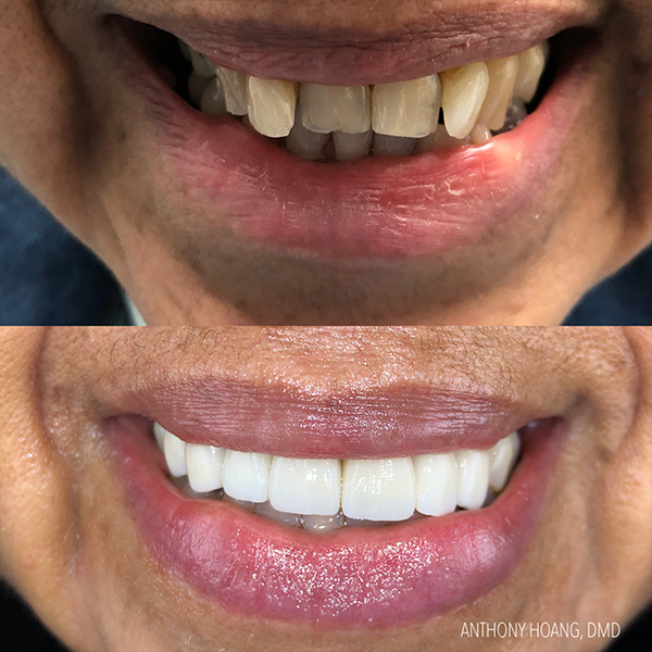 DentaL Before and After