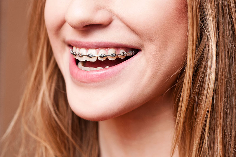 Orthodontics in Long Beach